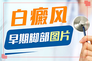 臉上出現白斑怎么治療-白駁風初期能治療嗎-如何治療白癜風