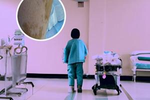 小孩臉上出現白斑怎么治療