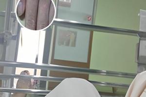 色素減退斑有什么前期癥狀表現怎么治療